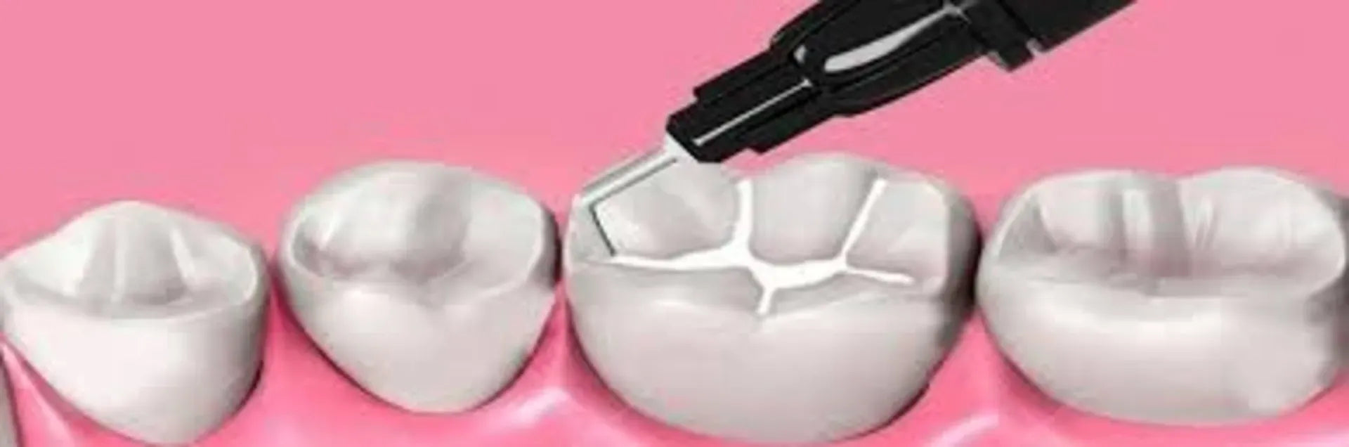 Sdi Wave Flowable Composite A3