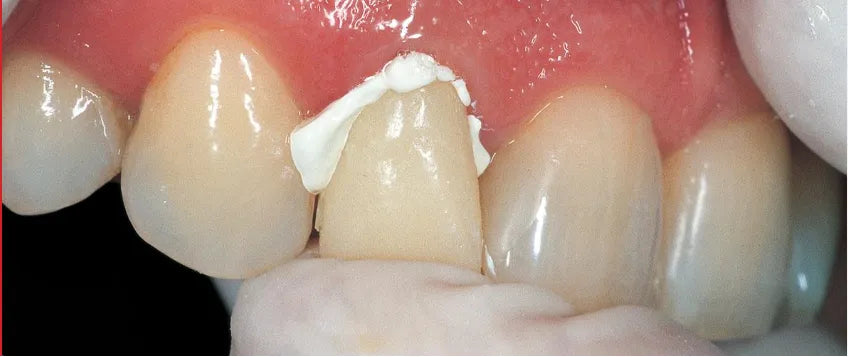 GC Freegenol 1-1 Pkg Temporary Luting Cement