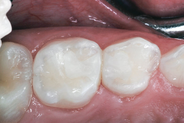 3m Espe Ketac Molar Gi Filling Cement