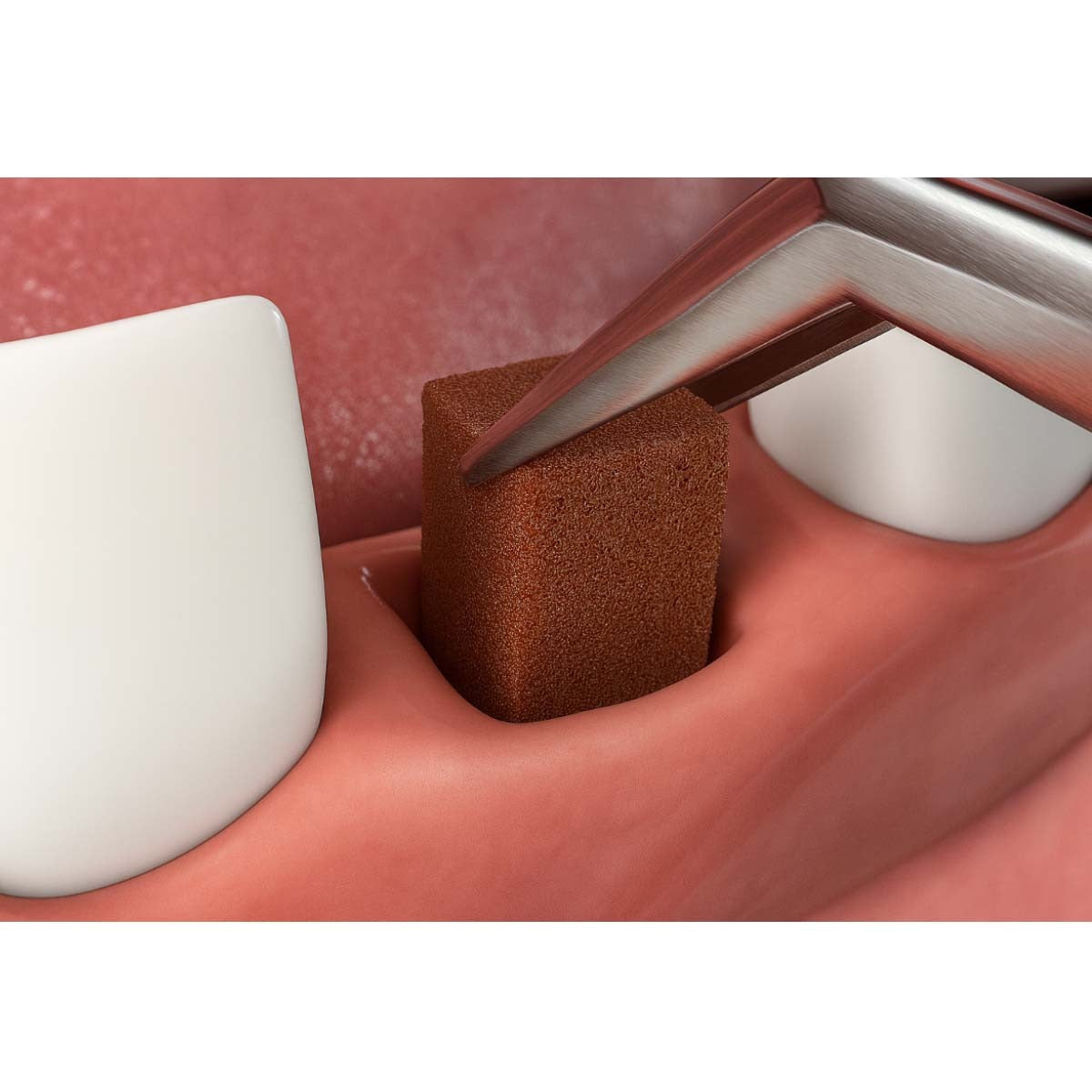 Coltene Gelasponge Absorbable Gelatine Sponge