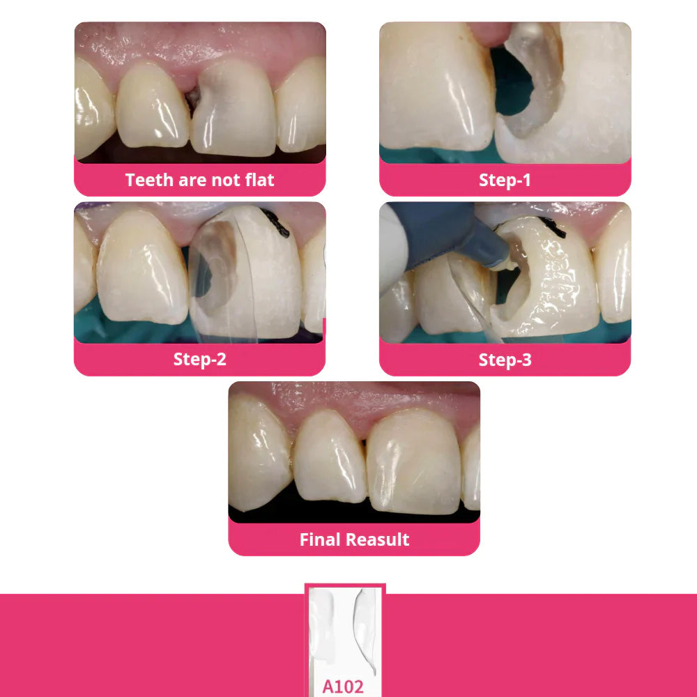 Bioclear Starter Matrix System Anterior Kit