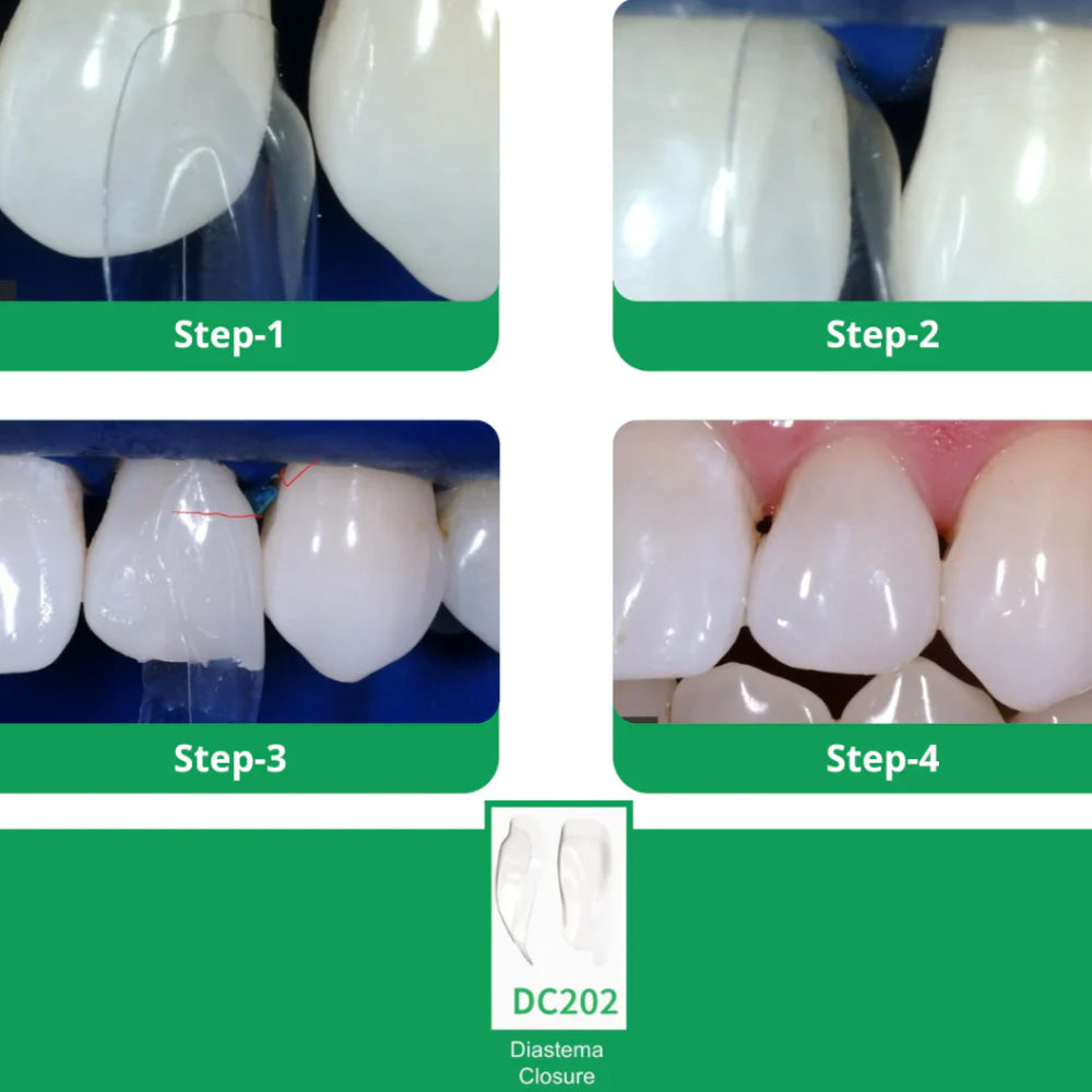 Bioclear Starter Matrix System Anterior Kit