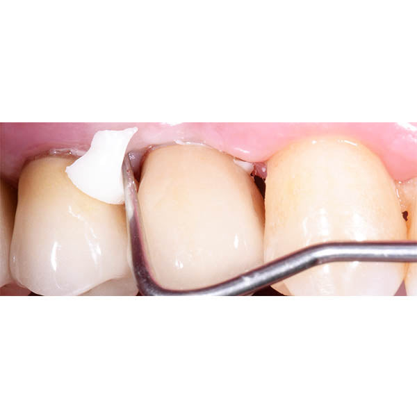 GC Gold Label 1 Luting & Lining Glass Ionomer Cement (GIC)