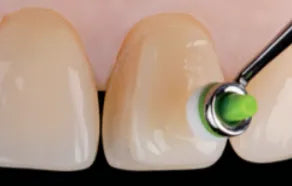 Ivoclar Optrasculpt Pad Kit & Refills