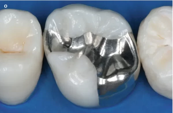 Waldent WalCap Amalgam Capsules - Image 2