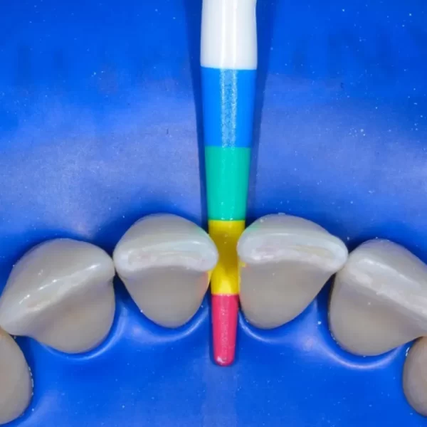 Bioclear Black Triangle Procedure Matrix System Kit - Image 2