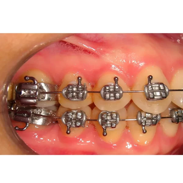 D-Tech Iridium Master (MBT Prescription Mini Brackets) - Image 2
